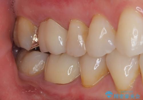 銀歯をやり替えたい フルジルコニアクラウン・ゴールドインレー修復の治療後