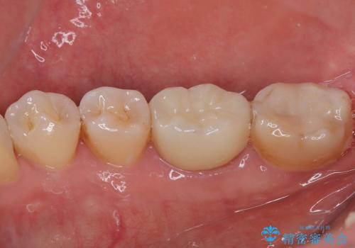 銀歯をやり替えたい フルジルコニアクラウン・セラミックインレー修復の治療後