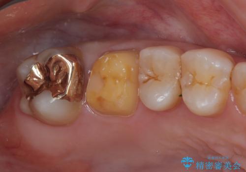 銀歯をやり替えたい フルジルコニアクラウン・ゴールドインレー修復の治療中