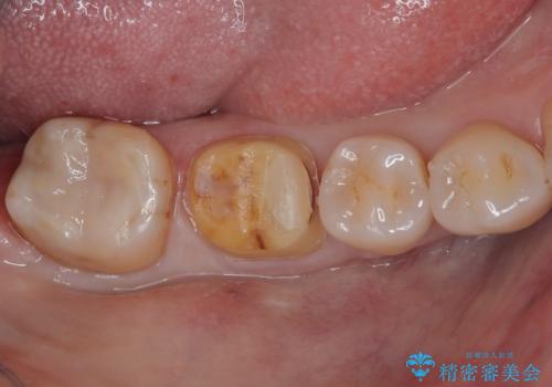 銀歯をやり替えたい フルジルコニアクラウン・セラミックインレー修復の治療中