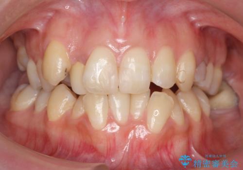 あきらめないで!!虫歯でボロボロでも大丈夫!　非抜歯矯正と虫歯、インプラント治療で見違える歯並びに。の治療前