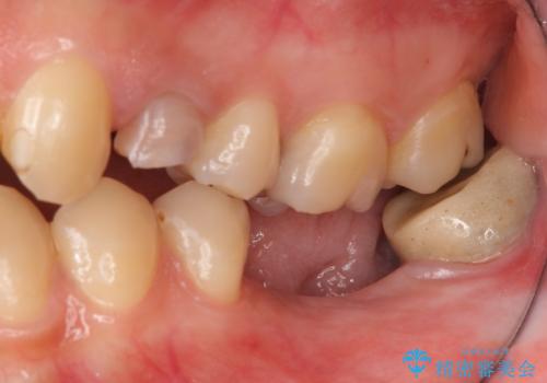 奥歯のインプラント