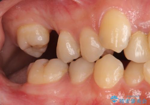 あきらめないで!!虫歯でボロボロでも大丈夫! 非抜歯矯正と虫歯、インプラント治療で見違える歯並びに。の治療前