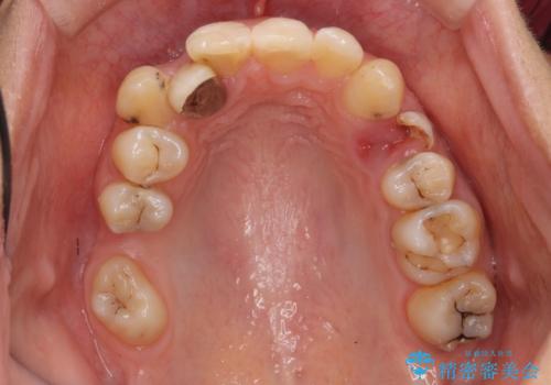 あきらめないで!!虫歯でボロボロでも大丈夫!　非抜歯矯正と虫歯、インプラント治療で見違える歯並びに。の治療前