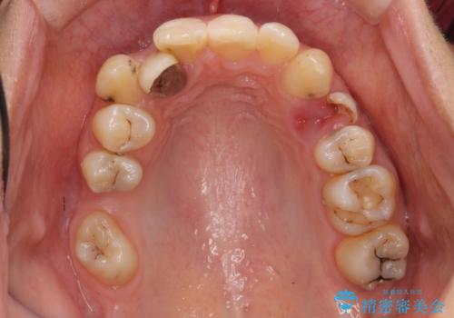 あきらめないで!!虫歯でボロボロでも大丈夫! 非抜歯矯正と虫歯、インプラント治療で見違える歯並びに。の治療前