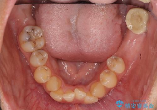 あきらめないで!!虫歯でボロボロでも大丈夫! 非抜歯矯正と虫歯、インプラント治療で見違える歯並びに。の治療前