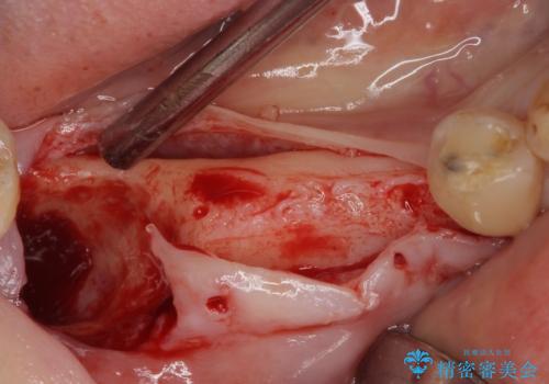 入れ歯が全く使えない 奥歯のインプラント治療の治療前