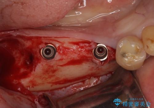 入れ歯が全く使えない 奥歯のインプラント治療の治療中