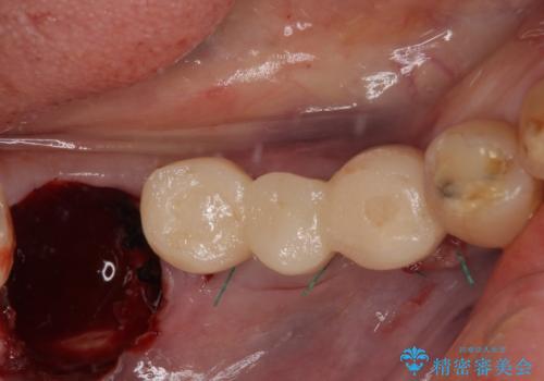 入れ歯が全く使えない 奥歯のインプラント治療の治療中