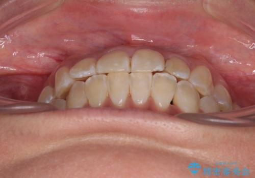 全く目立たないワイヤー矯正 上下裏側矯正の治療後