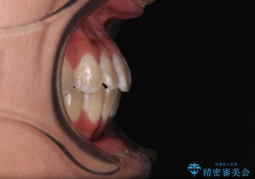 全く目立たないワイヤー矯正 上下裏側矯正の治療後