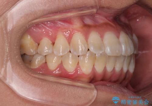 全く目立たないワイヤー矯正 上下裏側矯正の治療後