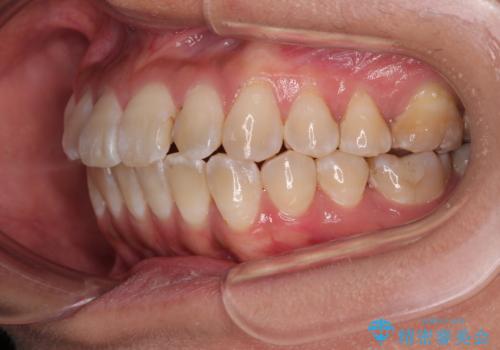 全く目立たないワイヤー矯正 上下裏側矯正の治療後