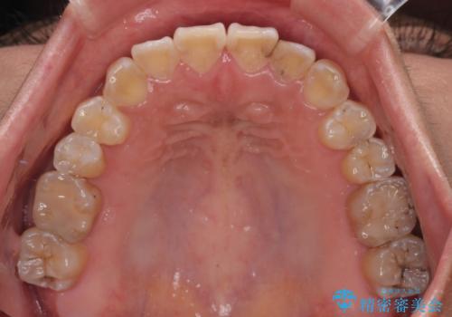 全く目立たないワイヤー矯正 上下裏側矯正の治療後