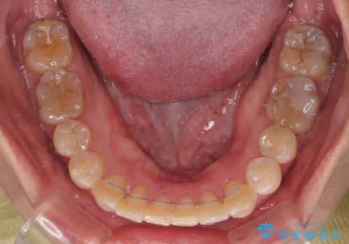 全く目立たないワイヤー矯正 上下裏側矯正の治療後