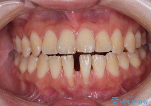 半分以上歯根が見えている 歯肉移植による根面被覆術の治療前