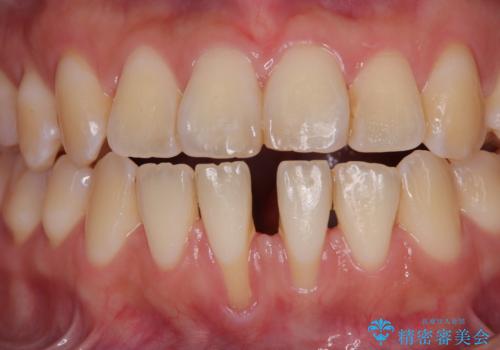 半分以上歯根が見えている 歯肉移植による根面被覆術の治療前