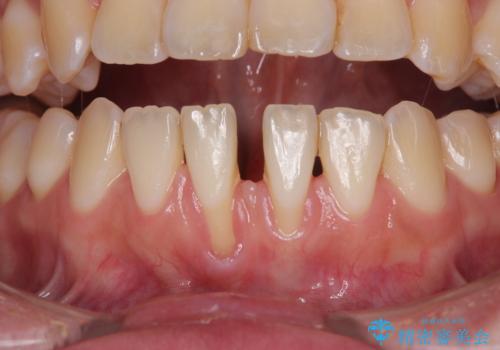 半分以上歯根が見えている 歯肉移植による根面被覆術の治療前