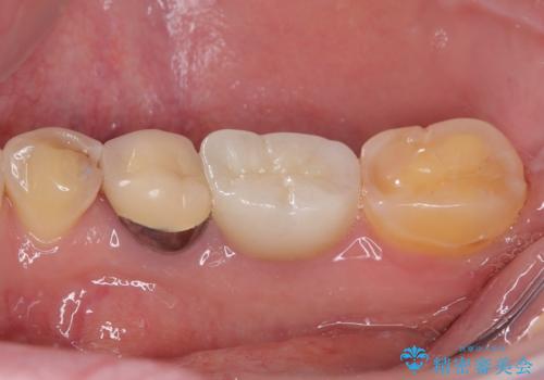 検診で見つかった齲蝕のセラミックインレー修復の治療前