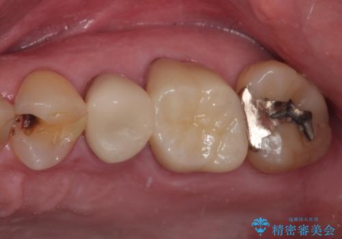 銀歯が取れたのでやり替えたい　セラミックインレー修復の治療前