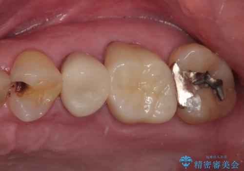 銀歯が取れたのでやり替えたい セラミックインレー修復の治療前