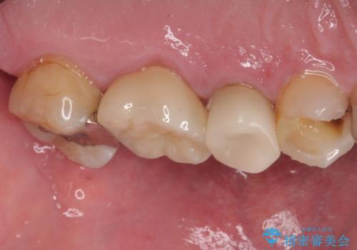 銀歯が取れたのでやり替えたい セラミックインレー修復の治療前