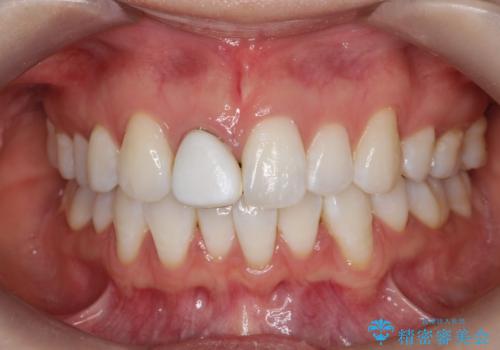 前歯の色・形が気になる オールセラミッククラウンで綺麗に (アライナー矯正併用)の治療前