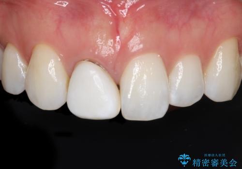 前歯の色・形が気になる オールセラミッククラウンで綺麗に (アライナー矯正併用)の治療前