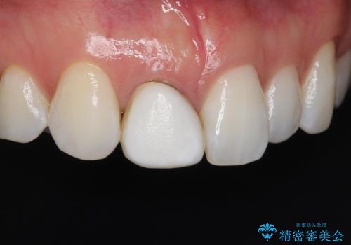 前歯の色・形が気になる オールセラミッククラウンで綺麗に (アライナー矯正併用)の症例 治療前