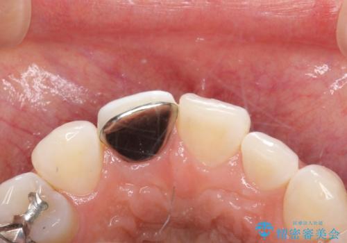 前歯の色・形が気になる オールセラミッククラウンで綺麗に (アライナー矯正併用)の治療前