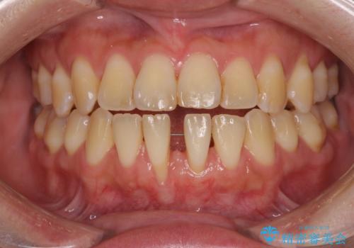 半分以上歯根が見えている 歯肉移植による根面被覆術の治療中