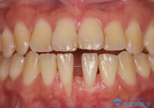 半分以上歯根が見えている　歯肉移植による根面被覆術の治療中