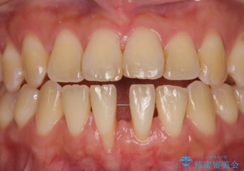 半分以上歯根が見えている 歯肉移植による根面被覆術の治療中