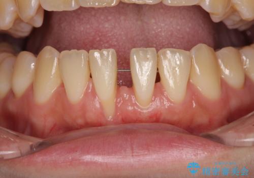 半分以上歯根が見えている 歯肉移植による根面被覆術の治療中