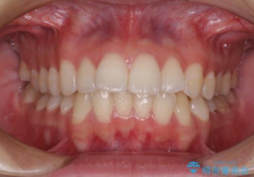 【モニター】前に傾斜した前歯 インビザラインでスッキリとした口元にの症例 治療前