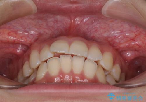 【モニター】前に傾斜した前歯 インビザラインでスッキリとした口元にの治療前