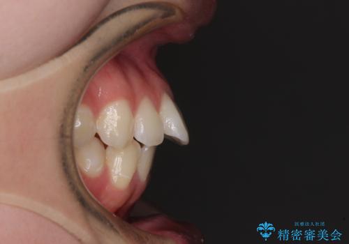 【モニター】前に傾斜した前歯 インビザラインでスッキリとした口元にの治療前