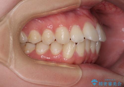 【モニター】前に傾斜した前歯 インビザラインでスッキリとした口元にの治療前