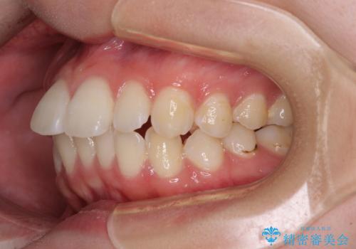 【モニター】前に傾斜した前歯 インビザラインでスッキリとした口元にの治療前