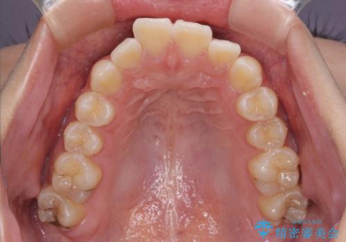 【モニター】前に傾斜した前歯 インビザラインでスッキリとした口元にの治療前