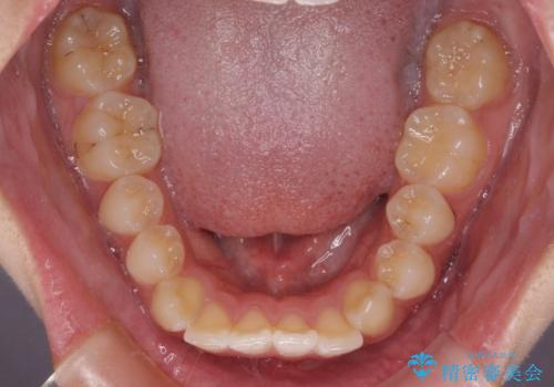 【モニター】前に傾斜した前歯　インビザラインでスッキリとした口元にの治療前