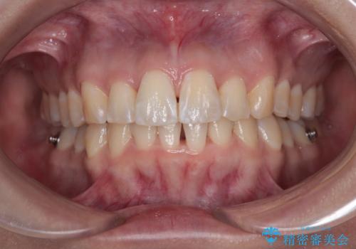 前に飛び出して目立っている前歯を整える インビザライン矯正治療の治療中