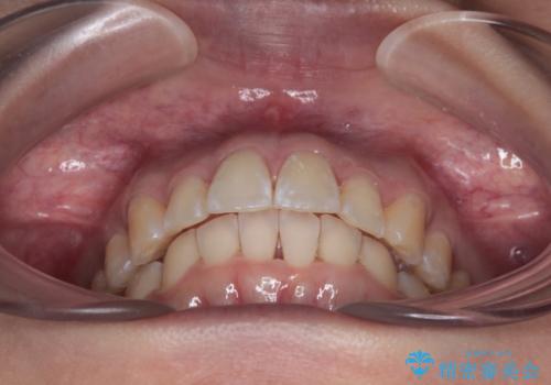 前に飛び出して目立っている前歯を整える インビザライン矯正治療の治療中