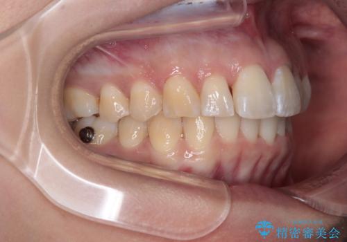 前に飛び出して目立っている前歯を整える インビザライン矯正治療の治療中