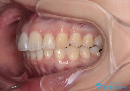 前に飛び出して目立っている前歯を整える インビザライン矯正治療の治療中