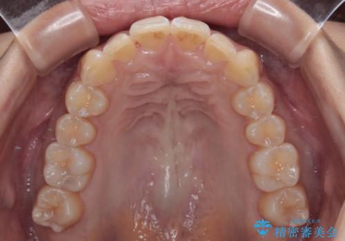 前に飛び出して目立っている前歯を整える　インビザライン矯正治療の治療中