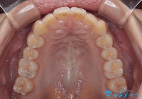 前に飛び出して目立っている前歯を整える インビザライン矯正治療の治療中