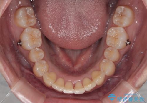 前に飛び出して目立っている前歯を整える インビザライン矯正治療の治療中