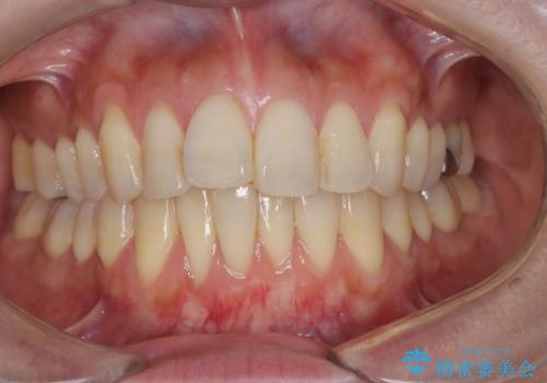 半年で改善した上顎前歯の突出