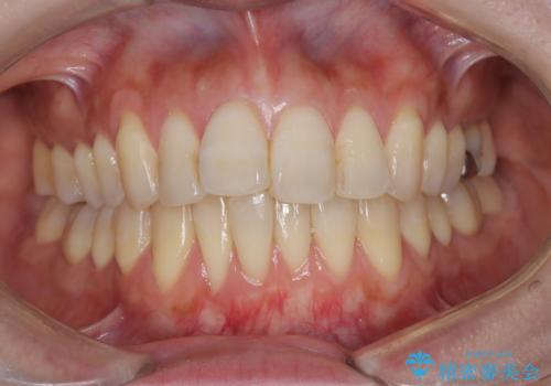 半年で改善した上顎前歯の突出の治療前